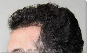 Hair restoration procedure results