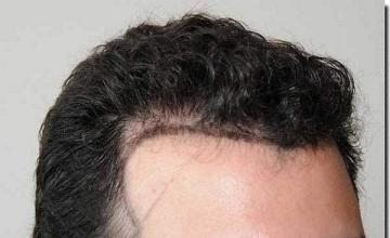 Hair restoration procedure results