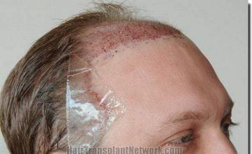 Hair restoration procedure results