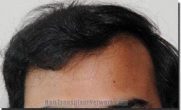 Hair restoration procedure results