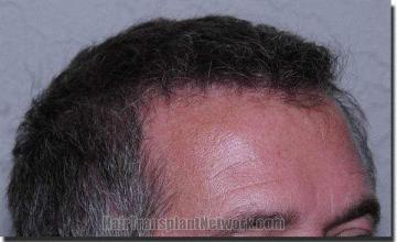 Hair restoration procedure results