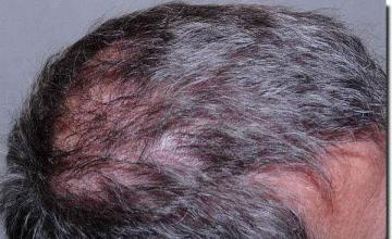 Hair restoration procedure results