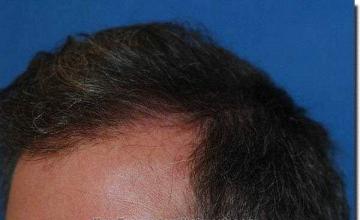 Hair restoration procedure results