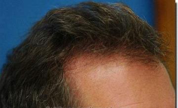 Hair restoration procedure results