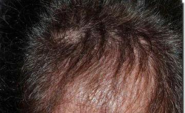 Hair restoration procedure results