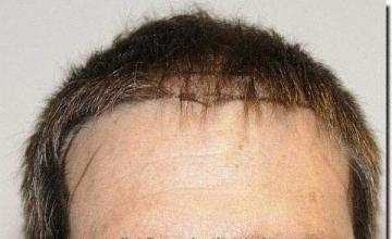 Hair restoration procedure results