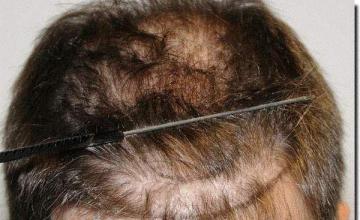 Hair restoration procedure results