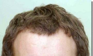 Hair restoration procedure results