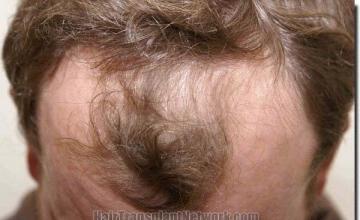 Hair restoration procedure results