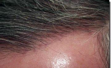 Hair restoration procedure results