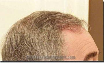 Hair restoration procedure results