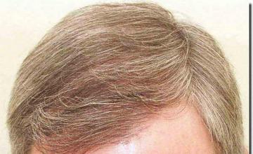 Hair restoration procedure results