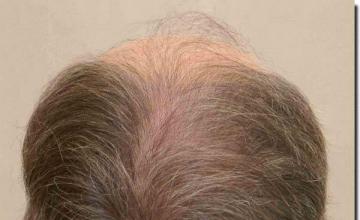 Hair restoration procedure results