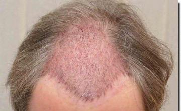 Hair restoration procedure results