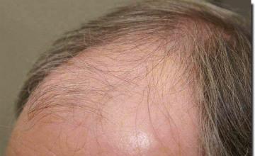 Hair restoration procedure results