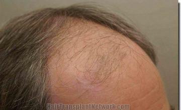 Hair restoration procedure results