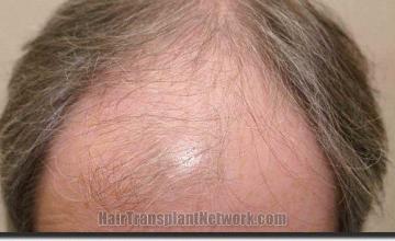 Hair restoration procedure results