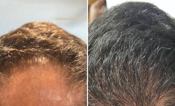 Before and after crown 