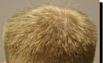 Hair restoration procedure results