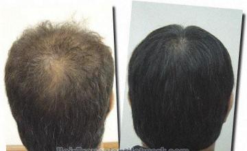 Hair restoration procedure results