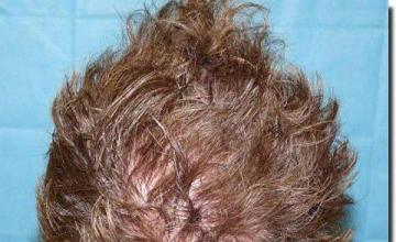 Hair restoration procedure results