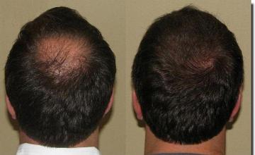 Hair restoration procedure results