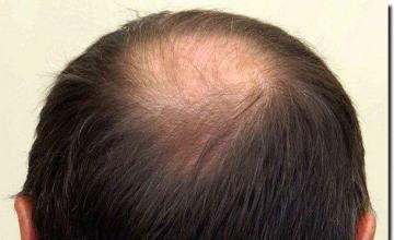 Hair restoration procedure results