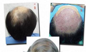 Hair restoration procedure results