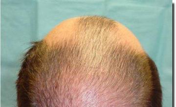 Hair restoration procedure results