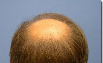 Hair restoration procedure results