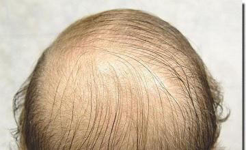 Hair restoration procedure results