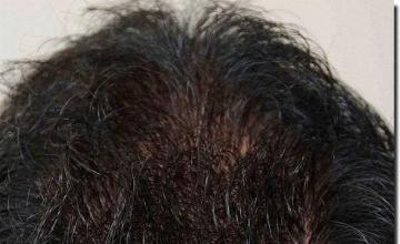 Hair restoration procedure results