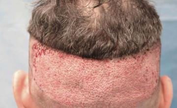 Back of patient, showing donor area immediately after FUE
