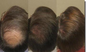 Hair restoration procedure results