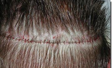 Hair restoration procedure results