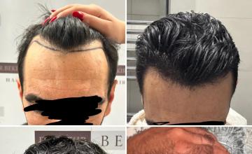 Before and After