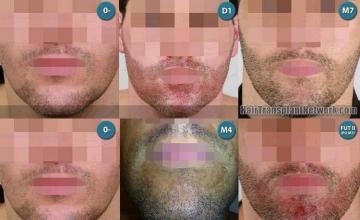 Beard transplantation surgery before and after photos