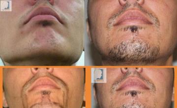 Beard transplant surgery before and after images