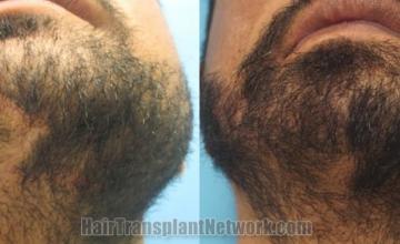 Front view - Before and after