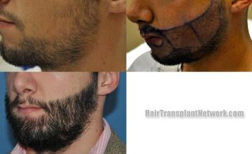 Hair transplant surgery before and after photos