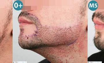 Beard transplant surgery before and after photos