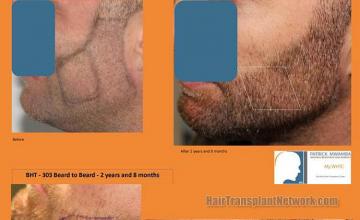 Beard transplantation surgery before and after photos