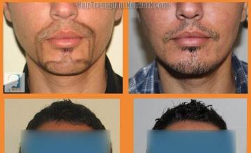 Beard transplant surgery before and after pictures