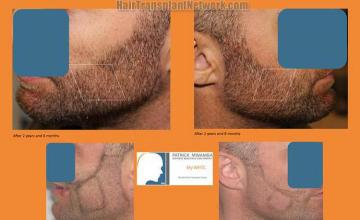 Beard restoration procedure before and after pictures