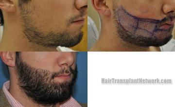 Hair transplantation surgery before and after images