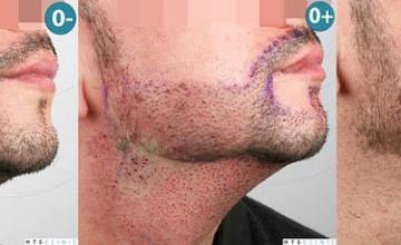 Beard transplant surgery before and after photos