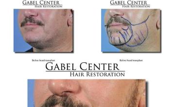 Hair restoration procedure before and after pictures