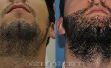 Hair restoration procedure before and after results