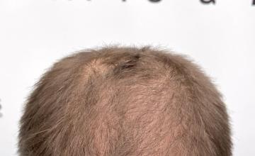 diffuse hair loss