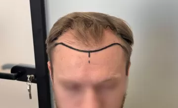 Before surgery 